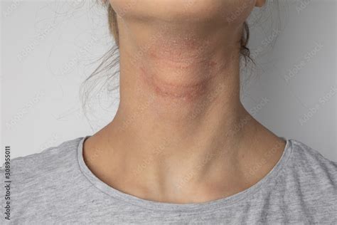 Allergic itchy skin on girl neck. Teen with rash dry skin on neck ...