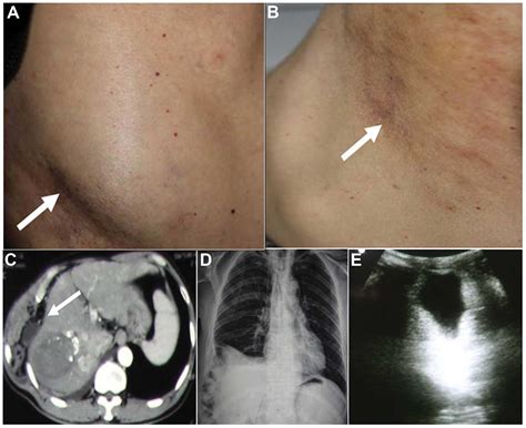 Chest wall hernia induced by high intensity focused ultrasound treatment of unresectable massive ...