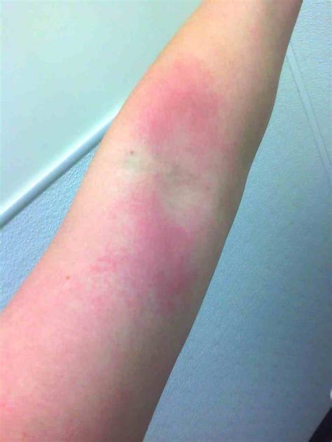 URTICARIA - www.medicoapps.org