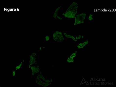 Kappa Light Chain Cast Nephropathy | Teaching Point | Arkana Labs