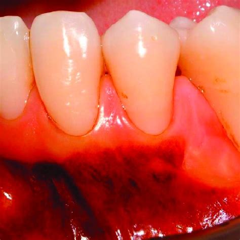 Histologic section of the area correspondent to the mucogingival ...