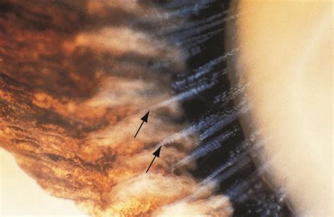 Pseudoexfoliation syndrome, AA0_55297 - The Cataract Course