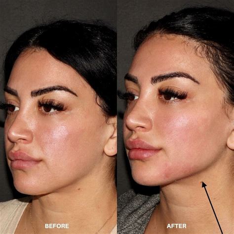 Juvéderm and Restylane | Hyaluronic Acid Fillers in West Hollywood