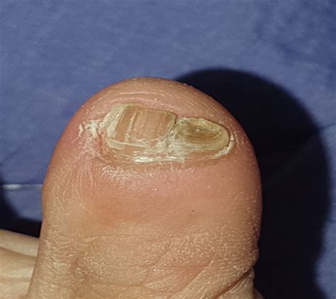 An Atlas of Nail Disorders, Part 5 | Consultant360