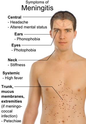 Viral Meningitis Symptoms