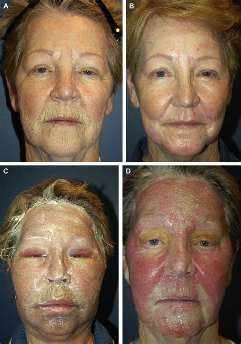 Phenol Chemical Peel Before And After