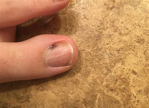 Melanoma under toenail pictures: black spot, nail melanoma pictures, toenail melanoma pictures ...