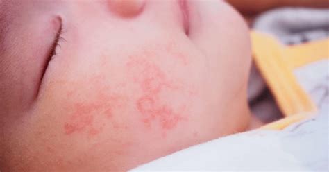 How To Identify, Treat, and Prevent Heat Rash in Children