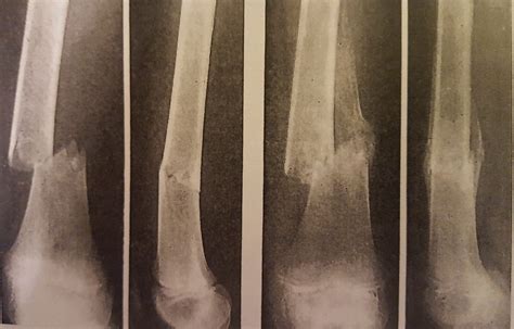 Pathology of Fractures and Fracture Healing - Momentum