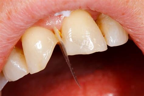 Types Of Teeth Fractures