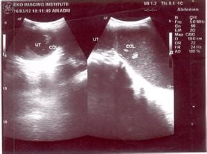 Ultrasound scan showing hematometra and hematocolpos. | Download ...