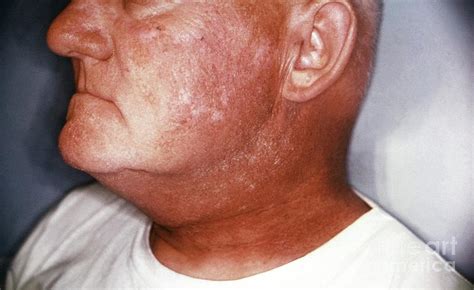 Radiation Dermatitis Of The Face Photograph by Cdc/science Photo Library - Pixels Merch