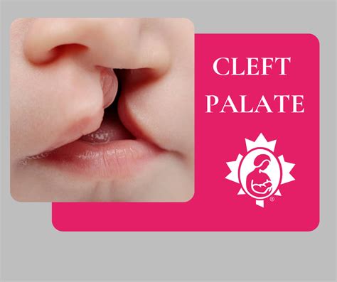 Feeding a Baby with a Cleft Lip and/or Cleft Palate | La Leche League Canada - Breastfeeding ...