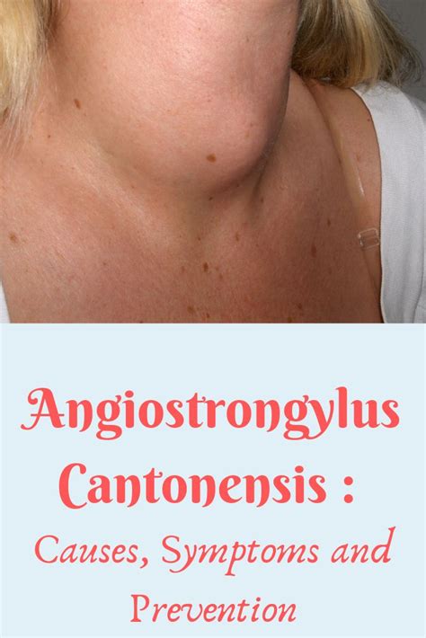 Angiostrongylus Cantonensis : Causes, Symptoms and Prevention ...