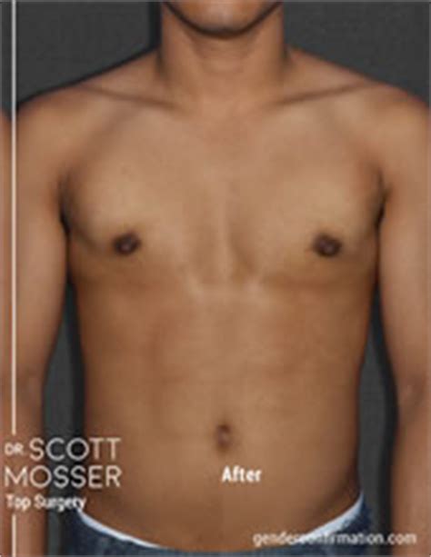 Dr. Scott Mosser - San Francisco's FTM/N Top Surgery Expert