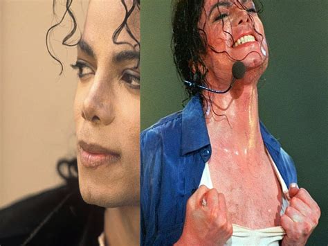 Michael Jackson Vitiligo Before And After