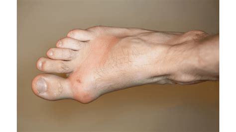 9 Pictures of the Gout: Symptoms, Food to avoid, other tips : Physiosunit