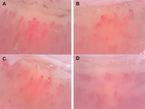 Nailfold capillaroscopy (200 x magnification): Capillary abnormalities... | Download Scientific ...