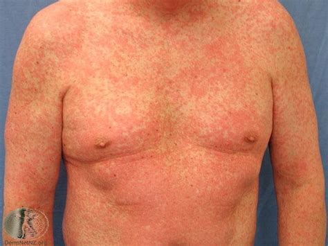 Common skin rashes and what to do about them — Richard Lebert ...