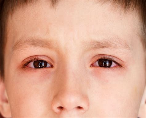 Pink Eye (Conjunctivitis): Causes, Symptoms & Treatment | Live Science