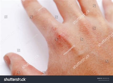 Mans Hand Chapped Skin Caused By Stock Photo 1882363165 | Shutterstock