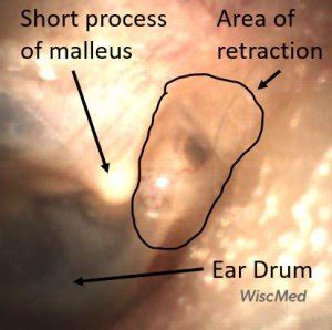 Eardrum Retraction - WiscMed