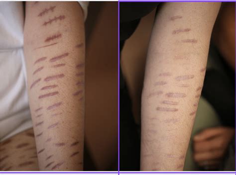 Self Harm Scar Treatment — Dr Nina Wines | North Shore Laser and ...