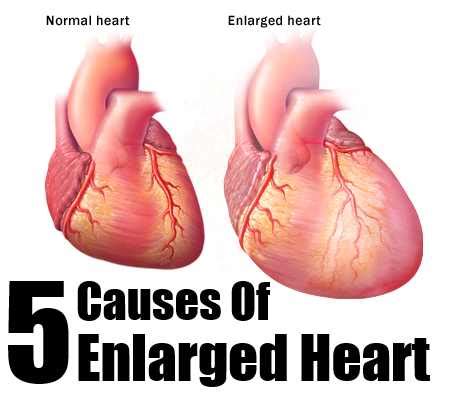 Five Major Causes Of Enlarged Heart – Natural Home Remedies & Supplements