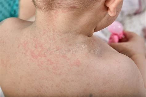 Roseola Rash a Viral Rash on the Skin of a Child Stock Photo - Image of little, children: 185081670