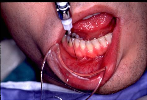 Techniques of Mandibular Anesthesia including Inferior Alveoar Nerve Block