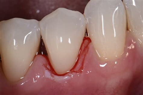 Cervical abrasion and root sensitivity