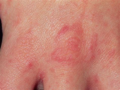 Scabies in children | BabyCenter