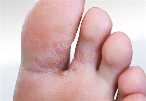 Fungal Infection - Relieve Foot Pain & Leg Pain