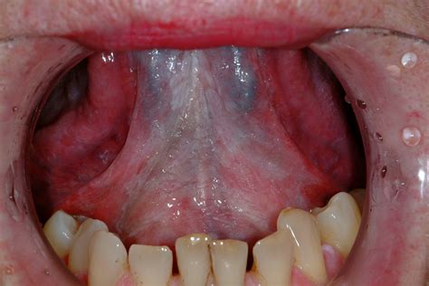 What Does Floor Of Mouth Cancer Look Like | Viewfloor.co