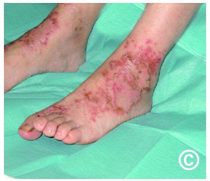 Necrolytic migratory erythema