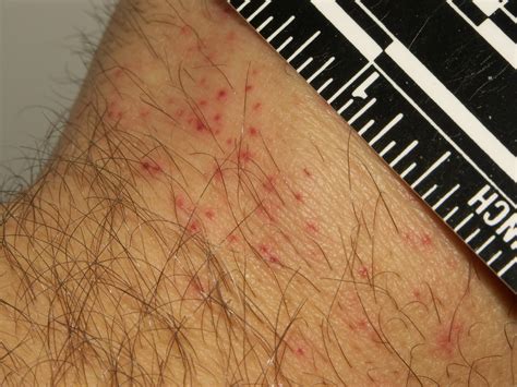 Bed bug bites visible hours after feeding | Bed bugs will cr… | Flickr