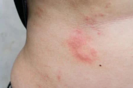 PUPPP Skin Rash During Pregnancy: Symptoms & Causes