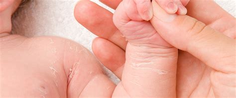 7 Ways to Naturally Deal with Baby Skin Peeling