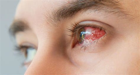 What syphilis is and how it can affect the eyes