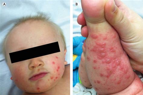 Atypical hand, foot, and mouth disease: a vesiculobullous eruption ...