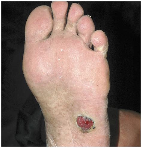 Melanoma of the Foot | NEJM