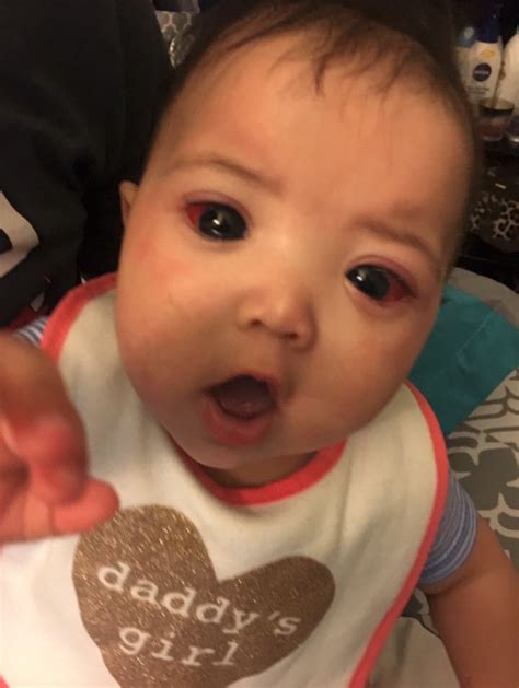 A Rare Genetic Condition Made This Little Girl's Eyes Look Big And Gorgeous