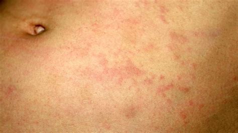 What Is The Medical Definition Of Pityriasis Versicolor - Printable ...