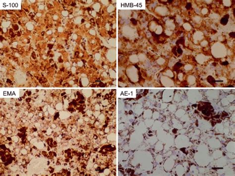 Immunohistochemical findings. Tumor cells showing positive... | Download Scientific Diagram