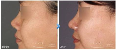 Aquiline Nose Surgery, Nose Shape Surgery In Korea | Nose surgery, Nose shapes, Beauty killer