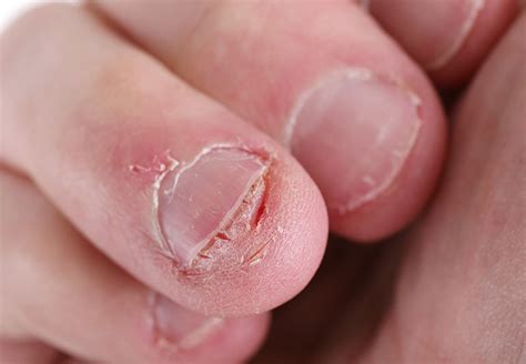 Infection from biting nails: Symptoms, Causes, and Treatment