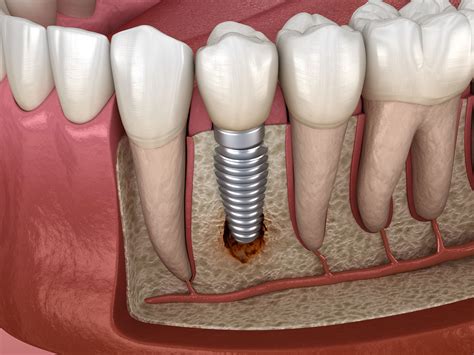 Tooth Implant Problems