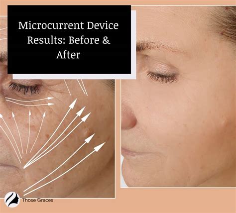 Microcurrent Device Results: Before & After - ThoseGraces.com