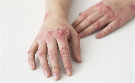 Ringworm Tinea Dermatophytosis: Causes Symptoms Signs, 44% OFF