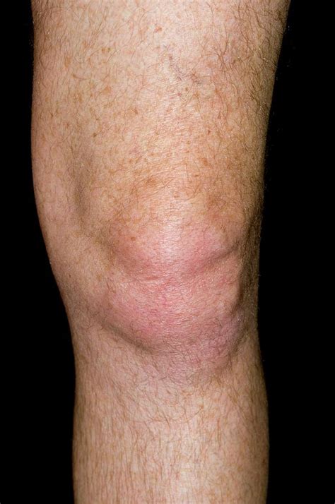 Gout Of The Knee Photograph by Dr P. Marazzi/science Photo Library